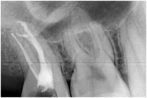 佐藤2　根管充填